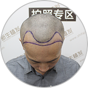 术前