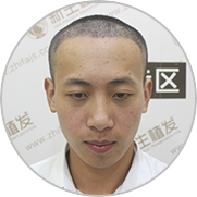 术后10天